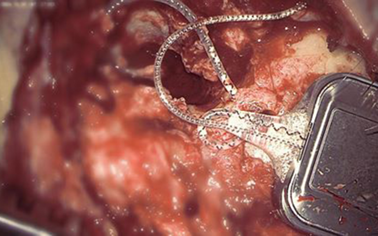 Cockpit Impressionen - Cochlea Implantat