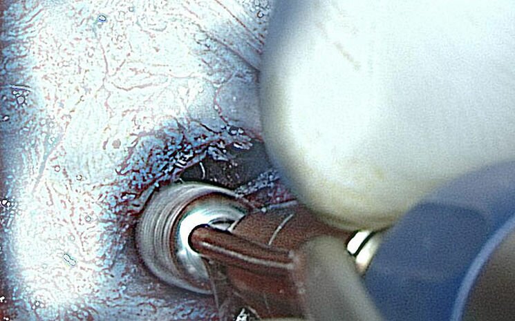 Mikrofräse mit Neuromonitoring-Funktion
